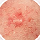 Red eczema-prone skin
