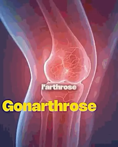 Illustration d'un genou arthrosique et d'une déchirure ligamentaire